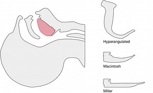 Differential Diagnosis of Technique for Video Laryngoscopy