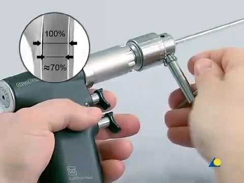 Femur shaft: long oblique fracture cerclage wire application and intramedullary pinning