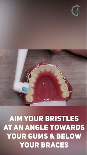 Brushing with Braces Explained - Electric Toothbrush #Shorts