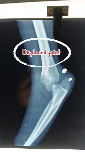Fall Injury in Child | Elbow Dislocation Successfully Reduced #medicosfactz #medicaleducation