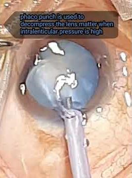 CCC in Mature Cataract by Dr. Atul Badiani