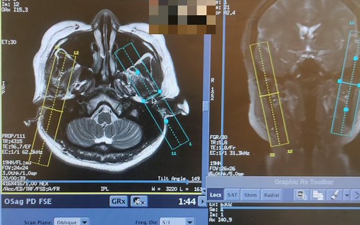 【磁共振扫描技术】GE 3.0T 磁共振 颞颌关节闭口位MRI平扫