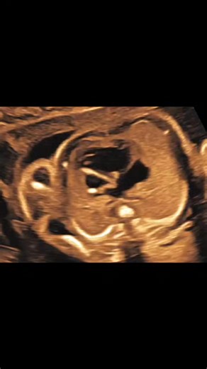 Prenatal Diagnosis of Hypoplastic Left Heart Syndrome (HLHS) A 35-year-old woman presented for a routine anomaly scan at 23 weeks and 4 days of gestation. There was no history of maternal illness, teratogenic exposure, or family history of congenital heart disease. Ultrasound Cardiac Findings On fetal echocardiography, there was marked asymmetry between the ventricles. The left-sided cardiac chambers were hypoplastic:The left atrium and left ventricle appeared significantly underdeveloped.The le