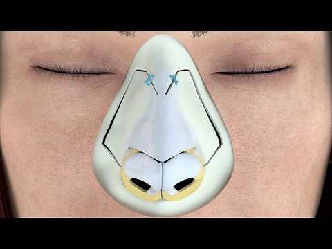 Piezotome® Rhinoplasty Protocol 3D