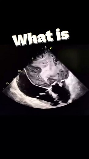 What is “Smoke” on Echo? That swirling, fog-like appearance inside the atrium is called Spontaneous Echo Contrast (SEC) — a sign of very slow blood flow. It forms when red blood cells start clumping together, scattering ultrasound and creating the “smoke.” SEC = blood stasis higher risk of clot higher risk of stroke, especially in: • Atrial fibrillation • Dilated or poorly contracting atria • Mitral valve disease • Low-flow states If you see smoke… look carefully for thrombus. 🫀🌀 | The Echo Jo