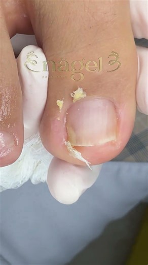 A unha dela encravava por isso #satisfying #nails