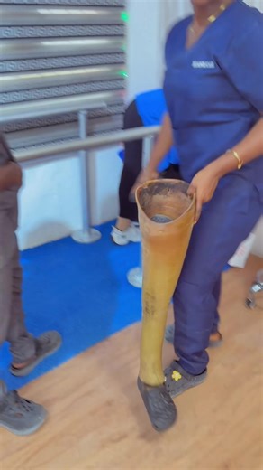 Old vs Modern Above-Knee Prosthesis: Advancements in Mobility