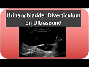 Urinary bladder diverticulum on ultrasound