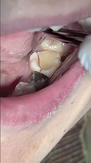 Fractured root canal treated molar tooth without crown #dentist
