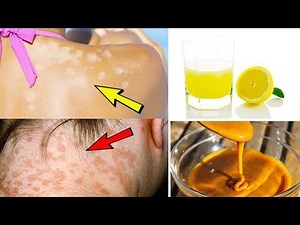 5 Effective Home Remedies For Treating Tinea Versicolor – Home Treatment Of Tinea Versicolor