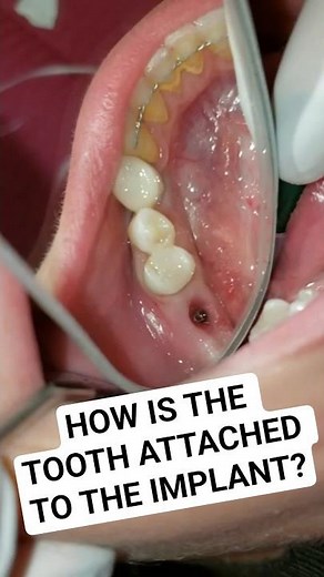 How is a crown attached to a dental implant?
