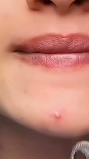 10M views · 13K reactions | AXCNE Cream — How It Works … • Calms...