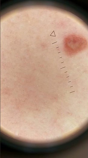Wobble sign bij dermatoscopie