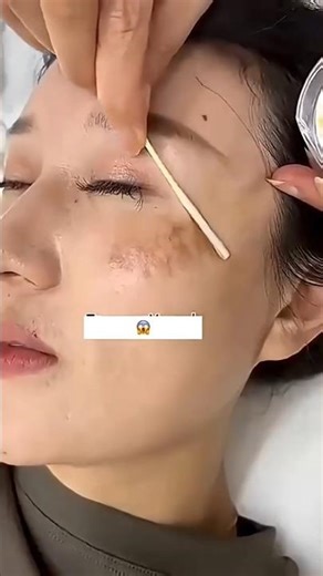 Pigmentation Treatment At Home | Dark Spots Remove Naturally#shortsfeed#ytshorts#skincare#pigmentati