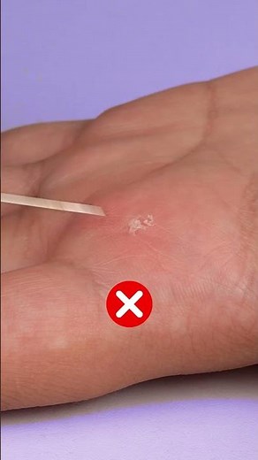 Easy splinter removal!🤔🤔