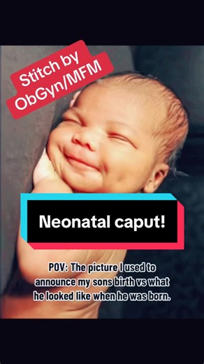 OP @themomtrotter Caput succedaneum is a common extracranial birth injury. It presents at birth after prolonged engagement of the fetal head in the birth canal or after vacuum extraction. Caput succedaneum is an edematous swelling of the scalp above the periosteum, which is occasionally hemorrhagic. Caput succedaneum can extend across the suture lines. It is typically diagnosed on examination and does not require imaging. Caput succedaneum is generally a benign condition, and it usually resolves
