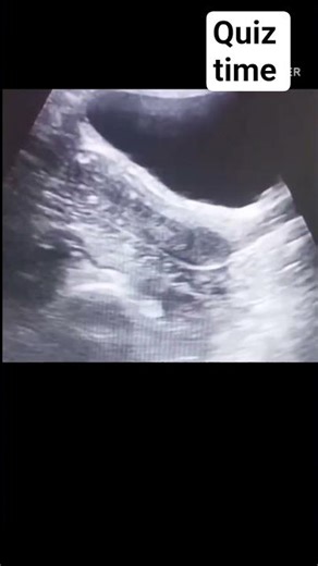Can you identify the abnormality here kindly leave your answer #ultrasound