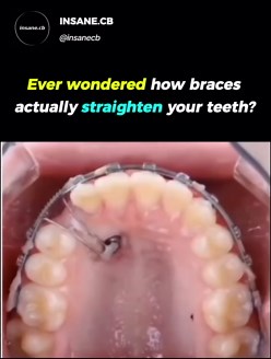How Braces Remodel Your Smile: Bone Remodeling Explained
