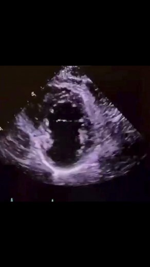 52K views · 305 reactions | 3 Things About Left Ventricular Aneurysms...