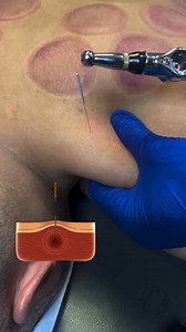 ⚡ Dry needling with electrical stimulation goes deeper than standard muscle work. The needle targets tight trigger points, while the stim boosts blood flow and helps calm the nervous system. This combo is especially effective for nerve irritation, stubborn muscle tension, and chronic pain that just won’t let up. It’s one of the most powerful resets we offer for long-term relief and improved mobility. 🔌🔥#DryNeedling #EStimTherapy #MobilityRecovery #ChiropracticCare #DrKyleRoss #chicagochiroprac