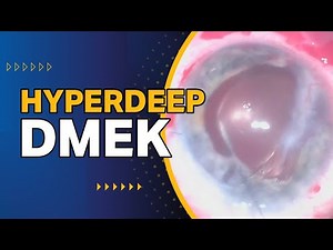 Hyperdeep DMEK