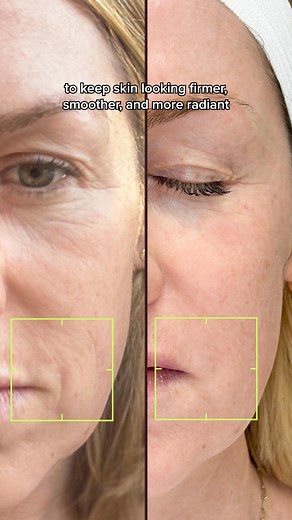 $75 ($275 Value) for your first laser facial - targets acne, hyperpigmentation, redness, fine lines, and dullness for glowing skin | Skin Laundry | Facebook