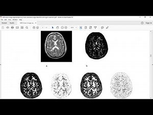 IMAGE SEGMENTATION BY MULTI-RESOLUTION EDGE DETECTION AND REGION SELECTION FOR MRI BRAIN