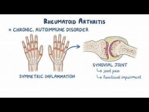 “Rheumatic Fever: Causes, Symptoms & Treatment Explained!”