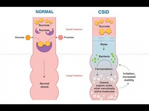 Sucrase enzyme deficiency Or sucrase isomaltase deficiency or sucrose intolerance ;Definition, Cause