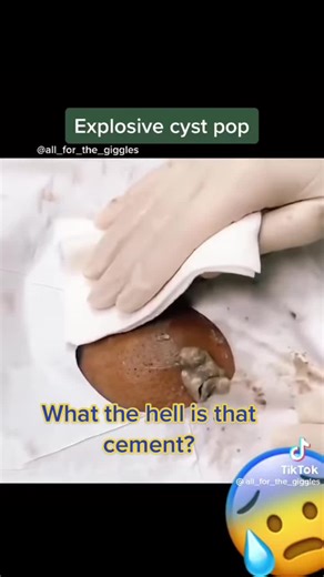 #fyp #reaction #warner #warn #pimplesandblackheads #pimplesandblackheads #dermdoctor #dermdoctor #cystexplosion #fypシ #blackhe #dermdr #dre #grossesse2022 #fypsi #gross