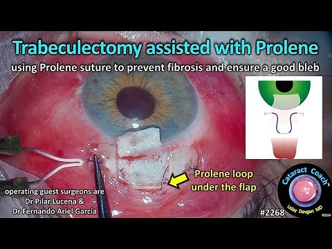 CataractCoach™ 2268: trabeculectomy assisted with Prolene suture