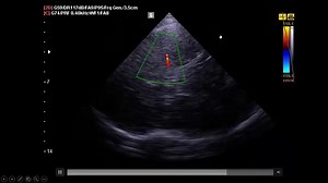 A simple way to diagnose MCA stenosis. For registration in our next hands on Brain U/S and TCCD course in the Egyptian Medical Syndicate, kindly contact Dr Doaa, the scientific coordinator on 00201065468005 WhatsApp. | Hands on critical care U/S courses