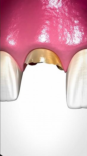 How Bone Grafting Works