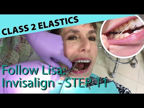 🦷 Follow Lisa: Invisalign 11 - Class 2 Elastics - why orthodontist must follow your progression