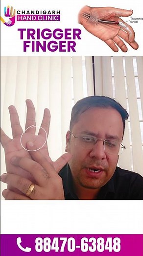 Trigger Finger: Causes, Symptoms & When to Seek Treatment