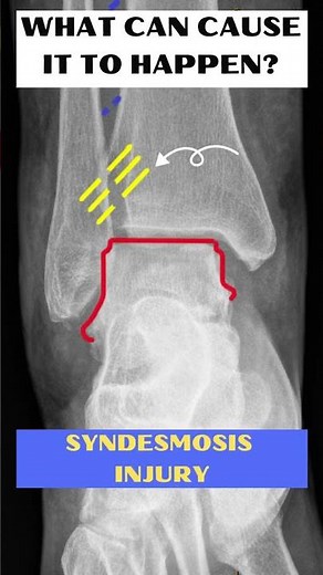What is TALAR SHIFT?