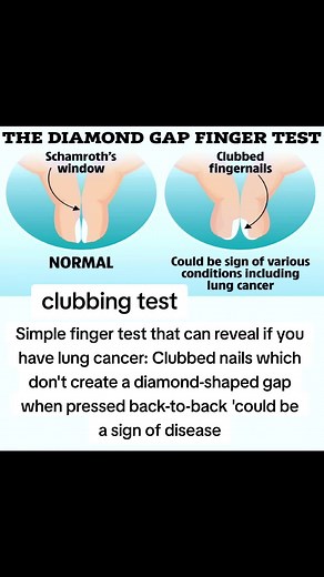 Lung Cancer Finger Test: Detect Clubbing Nails Signs