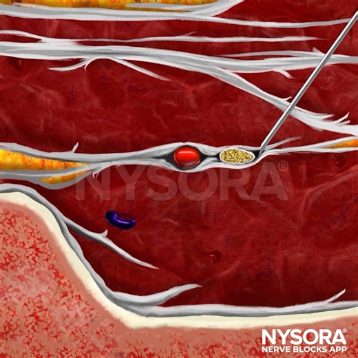 Now available in the NYSORA Nerve Blocks App: Greater Occipital Nerve Block The greater occipital nerve sits deep, with subtle landmarks and little margin for error. Success depends on reading ultrasound correctly - and knowing exactly what you’re looking at. NYSORA’s Reverse Ultrasound Anatomy (RUA) bridges that gap by placing ultrasound images into clear anatomical context. You see where the nerve lies between the obliquus capitis inferior and semispinalis capitis, how to choose a safe needle 