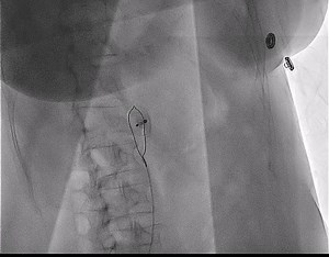 3.2K views · 54 reactions | This #JACCCaseReports study shows another rare complication two weeks after left atrial appendage occlusion device with migration causing acute #HeartFailure, left bundle branch block, and atrial flutter. Diagnosis of device migration or embolization is rare but essential. Learn more: https://bit.ly/3aem98C #vhdMR #AFib | JACC Journals | Facebook