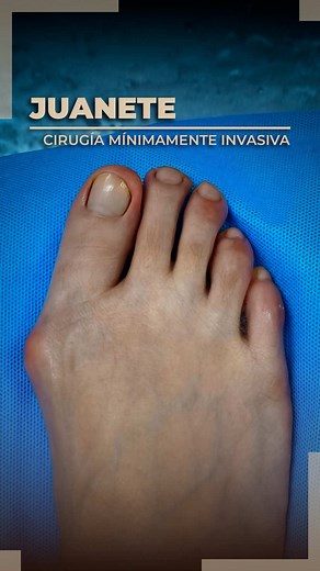 Corrección del hallux valgus con cirugía mínimamente invasiva