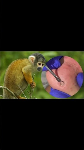 Removing Acne Blackheads on skin, cleaning everywhere
