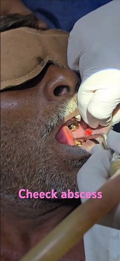 Cheeck abscess , drainage , i and d, drainage of abscess - Dr Hitesh Patel