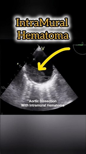 Aortic Dissection with IntraMural Hematoma #heart #heartdisease #Aortic #echocardiography