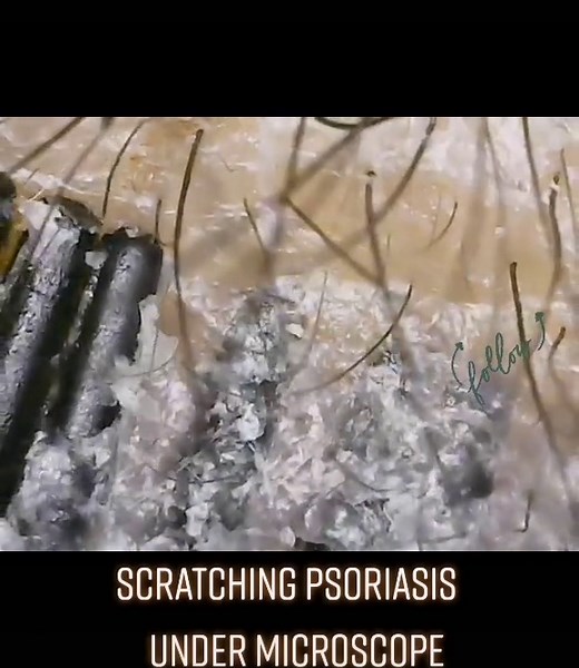 Examining Psoriasis and Eczema Under a Microscope
