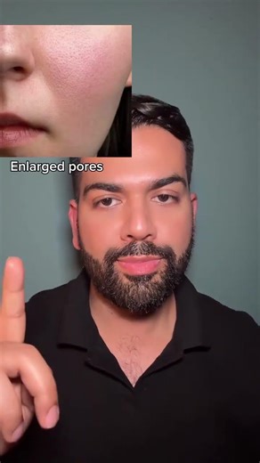 Perioral Dermatitis Sulfur reduces inflammation and kills bacteria that trigger perioral dermatitis