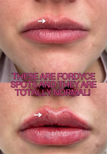 Crema Belani: Solución Efectiva para Manchas de Fordyce