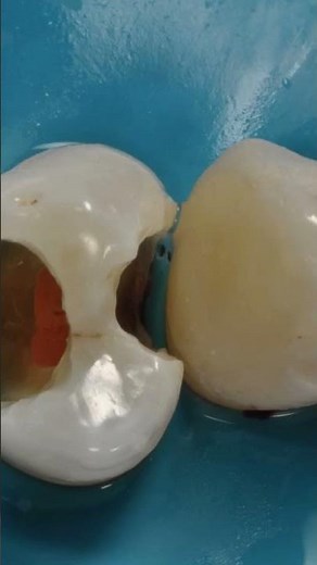 Irreversible pulpitis for both 2.3 and 2.4 We started by isolation and endodontic treatment