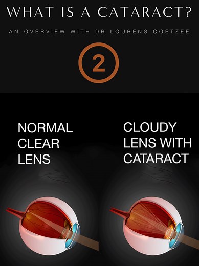 What is a Cataract? Learn what a cataract is, how it affects your vision, and when to visit your eye care specialists. Read more in our detailed guide: https://zurl.co/N2H9 #CataractSurgery #SandtoneEyeClinic #DrLourensCoetzee