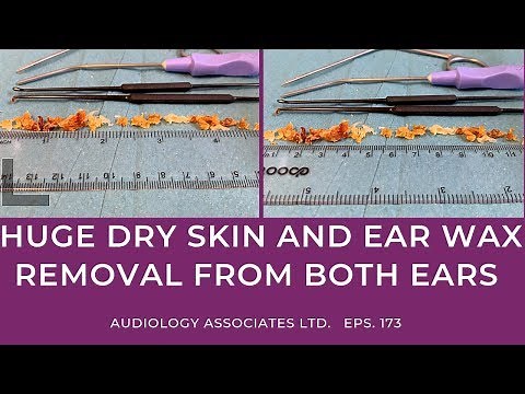 HUGE DRY SKIN AND EAR WAX REMOVAL FROM BOTH EARS - EP173