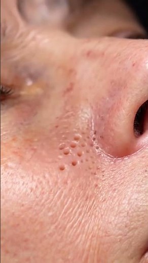 Blackhead Extraction Moment — Satisfying